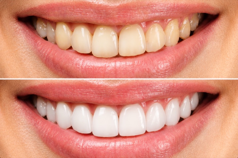 Before and after teeth whitening — yellowed teeth above, brighter white smile below