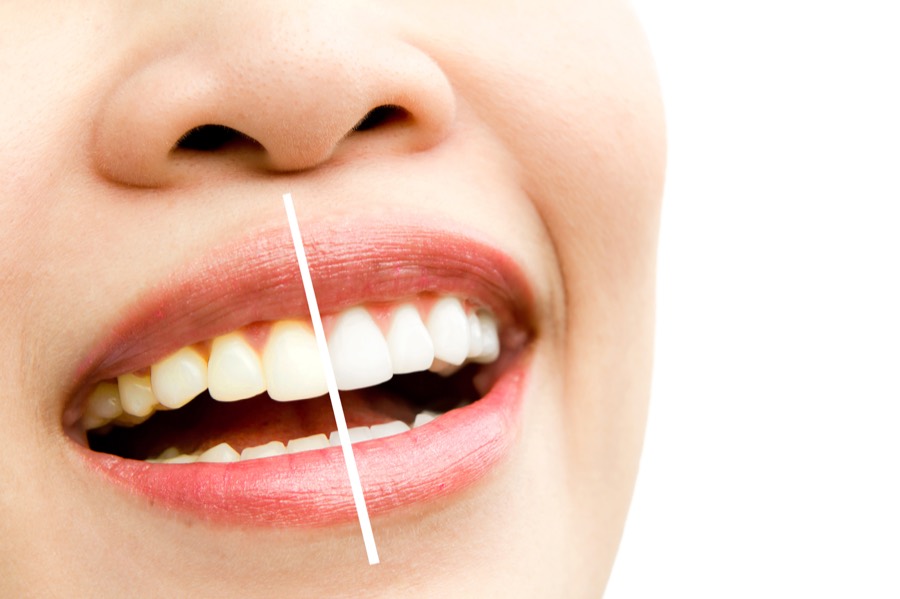 Before and after teeth whitening — left side natural yellow, right side brighter white